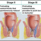 Illustration for article titled Cara mengobati wasir internal
